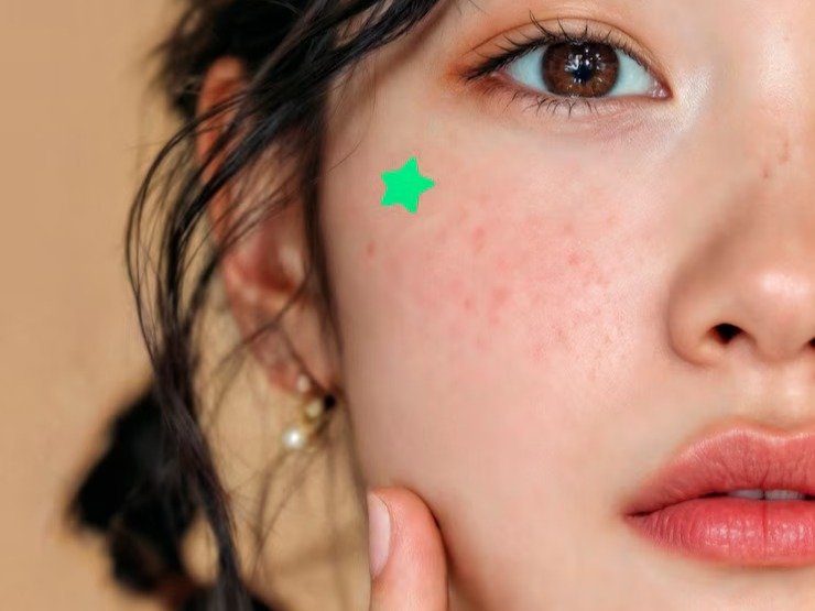 The Dreaded Purge – When Is an Acne Outbreak Natural or Man-Made?