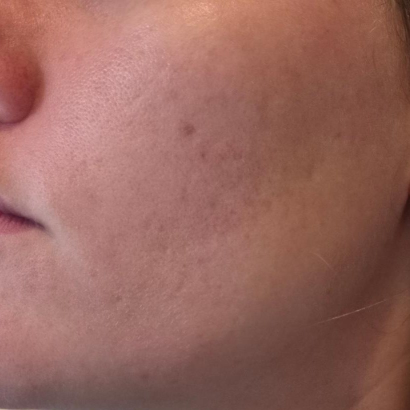 After Celimax Ji Woo Gae Cica BHA Blemish Toner Pad Use