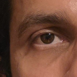 Eye After Using Medicube Kojic Acid Eye Gel Serum