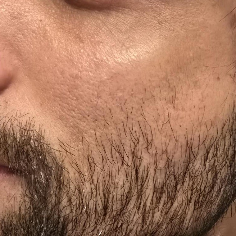 After 2 Weeks Picture (AGE-R Glutathione review) same lighting, more glow and lift to skin
