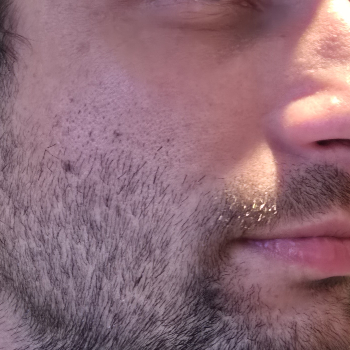 Right cheek before using Ultimate Beautician Gift Set