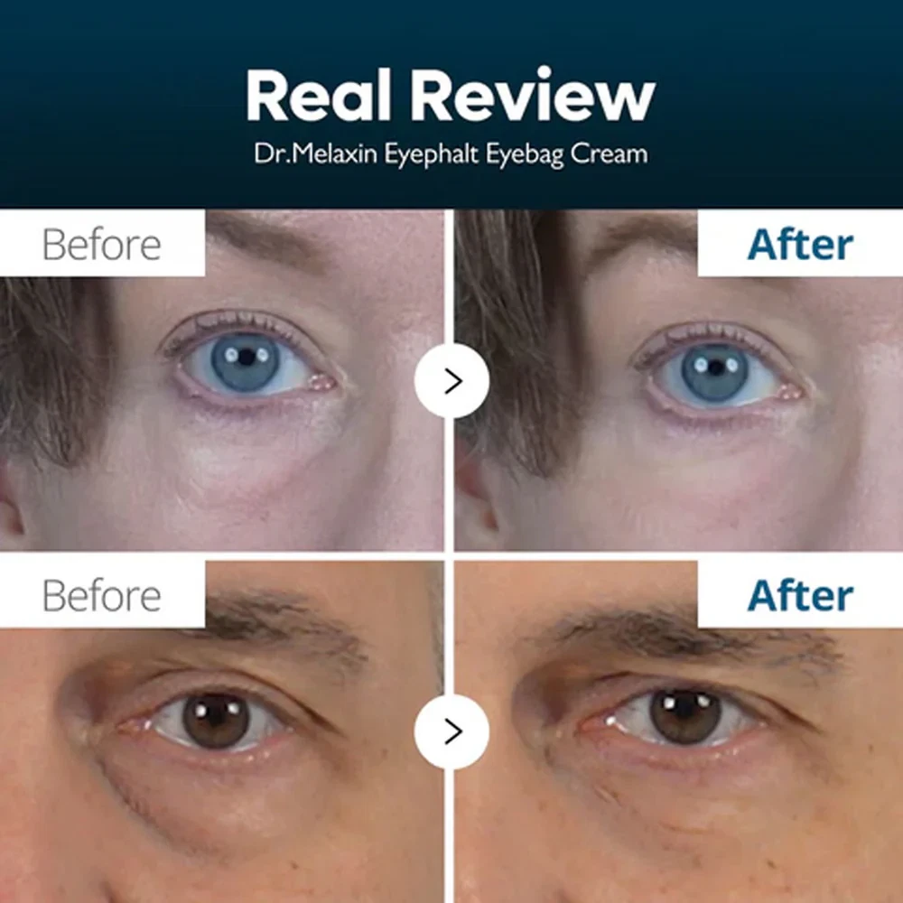 Dr Melaxin Eyephalt Eyebag Before and After Pictures