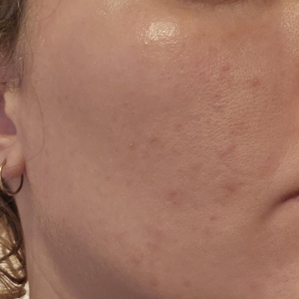 Close Up Cheek Before Using Dr Jart+ Teatreement Cleanser