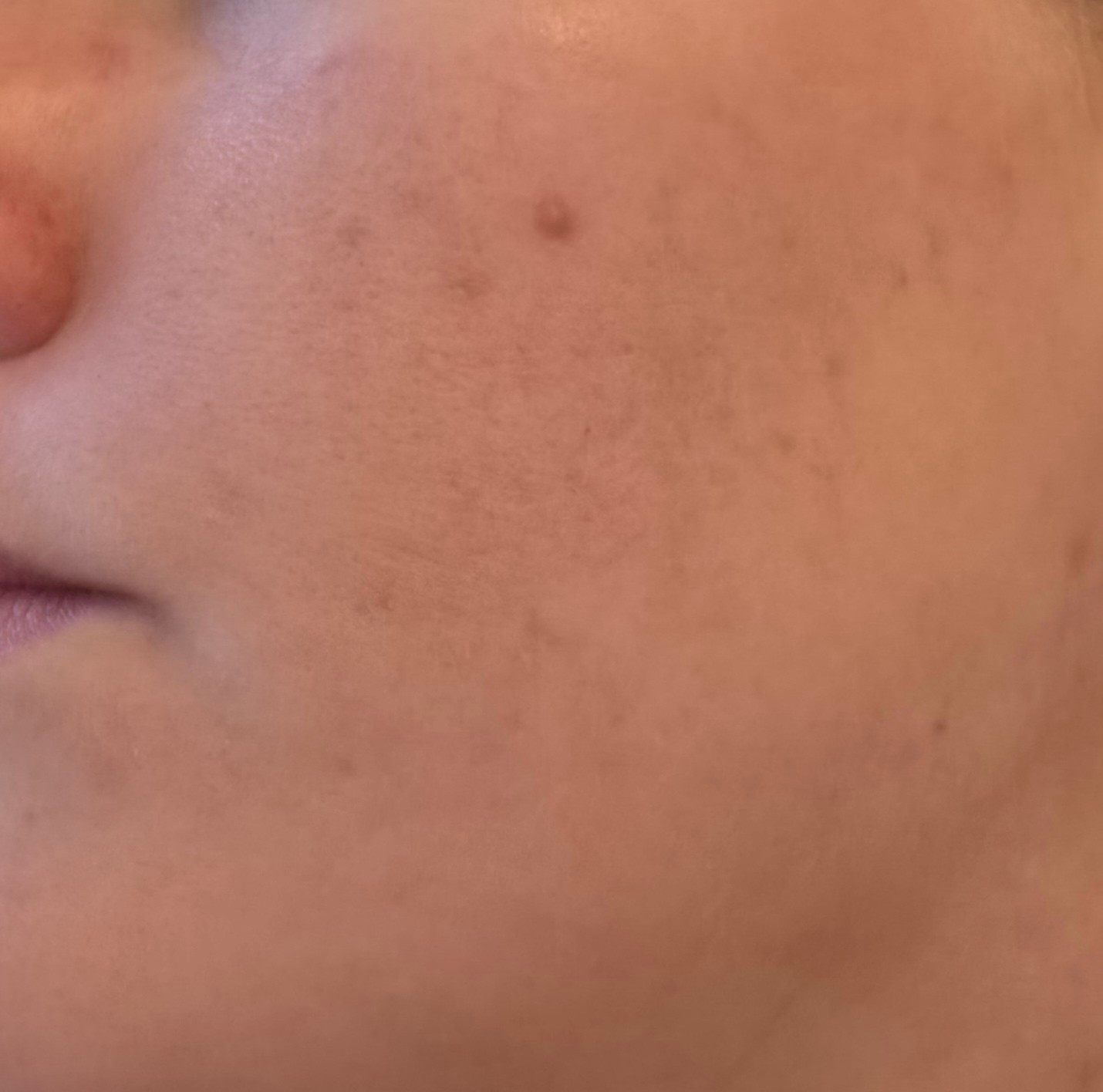 Face after using Anua Azelaic Acid 10 Hyaluron Soothing Serum