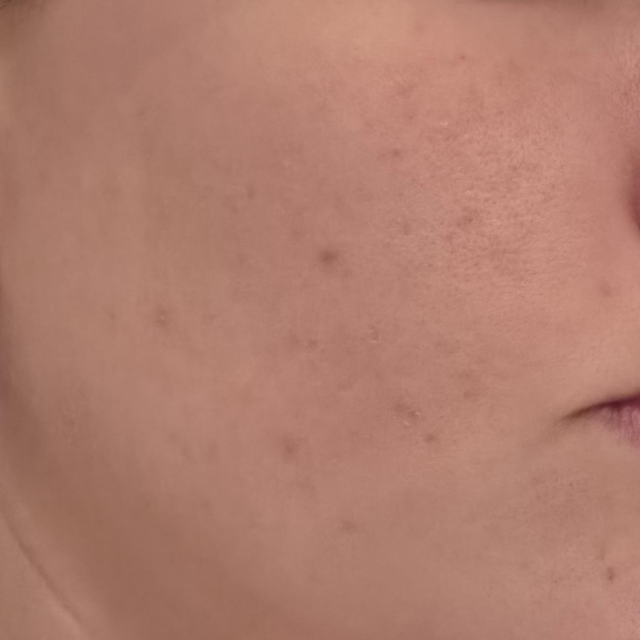 Skin barrier after using Medicube Zero Pore Sun Serum