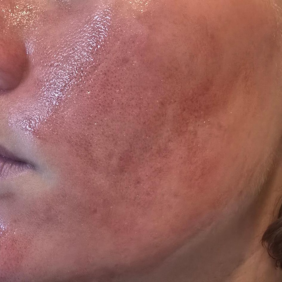 Hemish Rx AHA BHA serum application to face