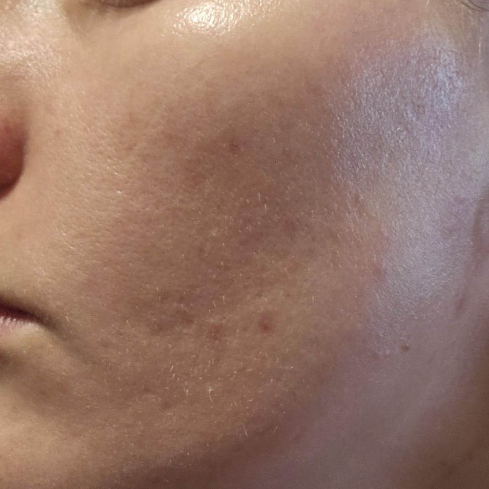Skin without using Medicube Zero Pore Pads 2.0
