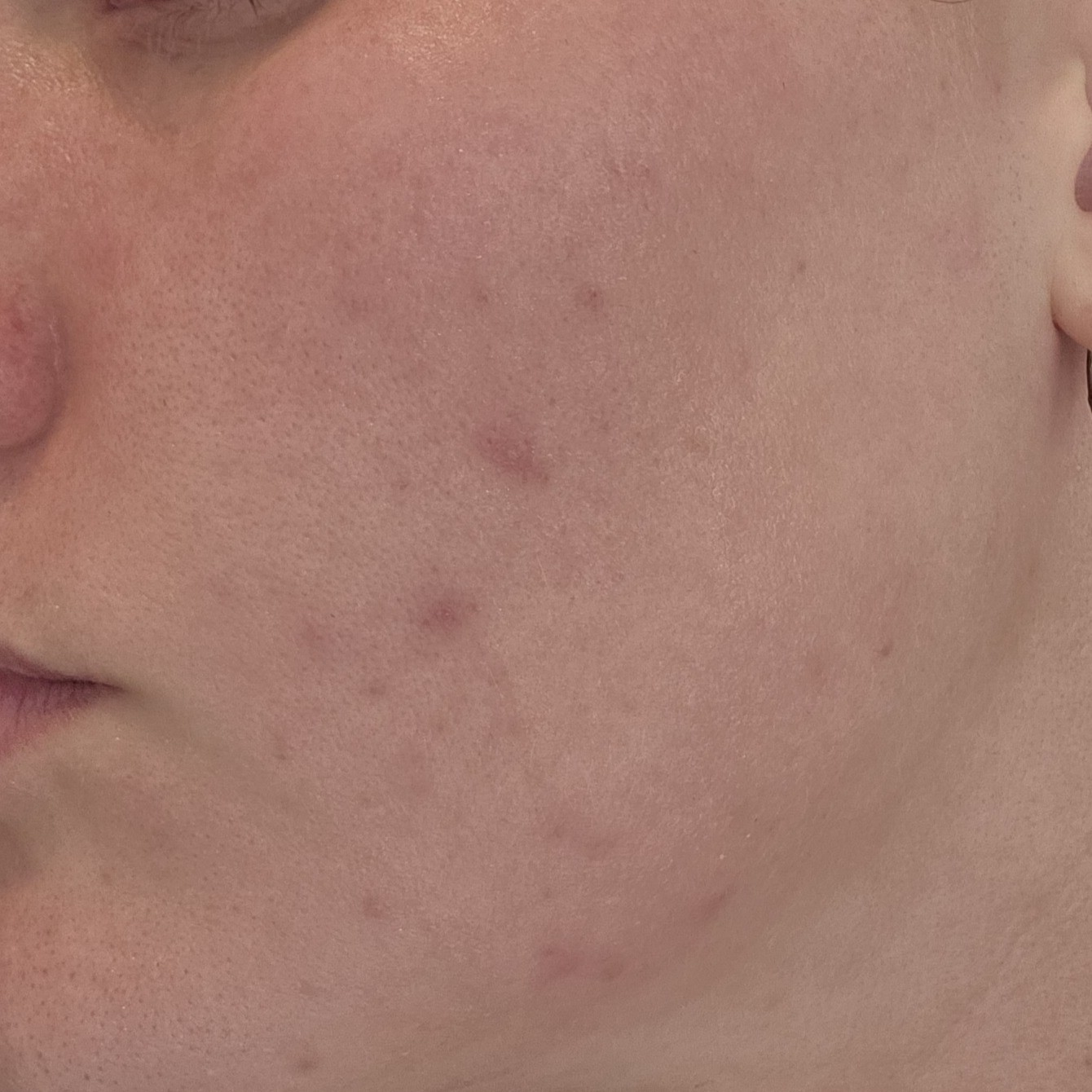 Face before using Beauty of Joseon Ginseng Essence Water