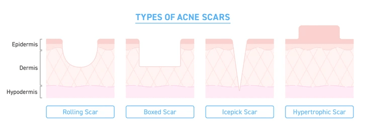 Types of acne scarring diagram based on dermatology studies
