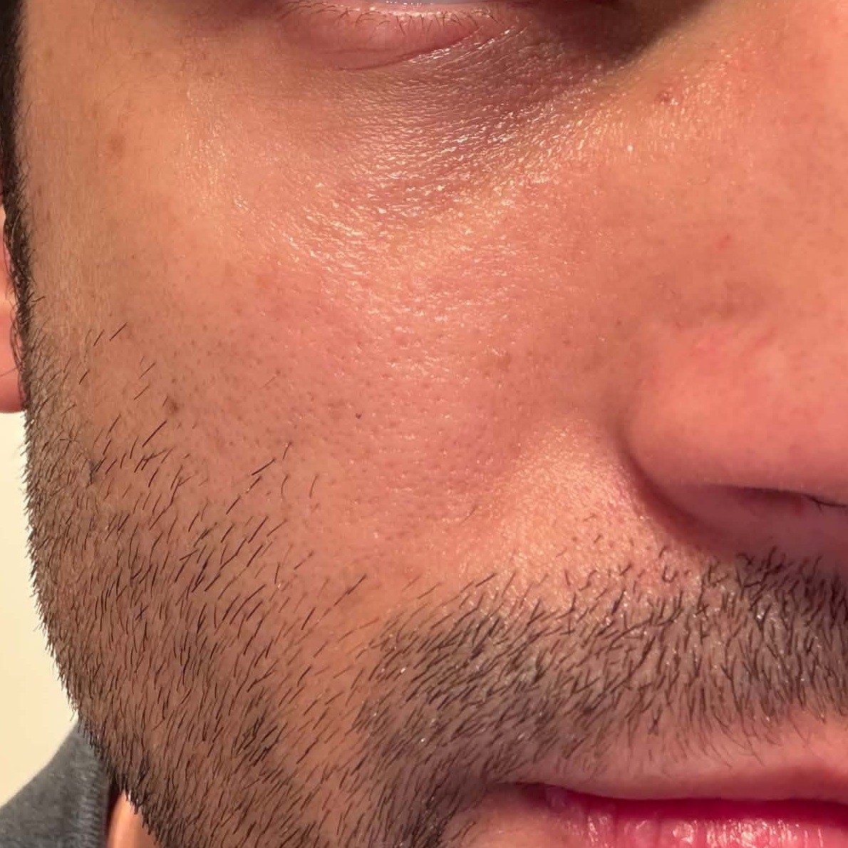 Skin After Using Abib Glutathione Dark Spot Pad