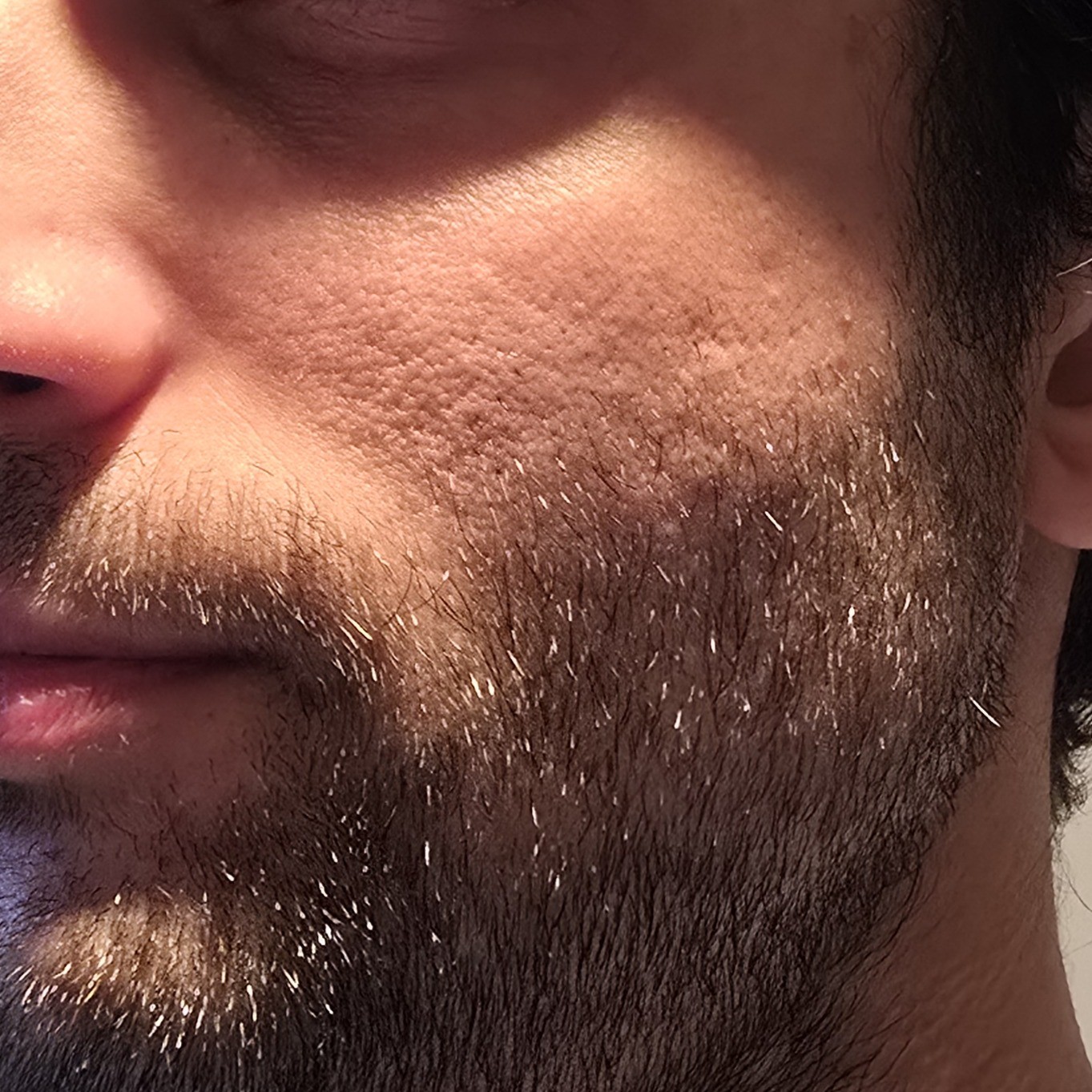 Left cheek before using Ultimate Beautician Gift Set