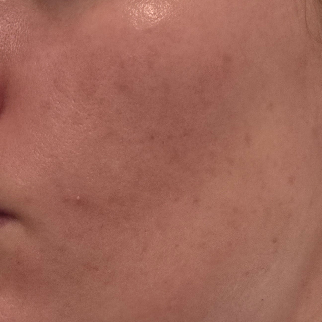 After picture (cheek close up) showing smaller and more sparse acne scars