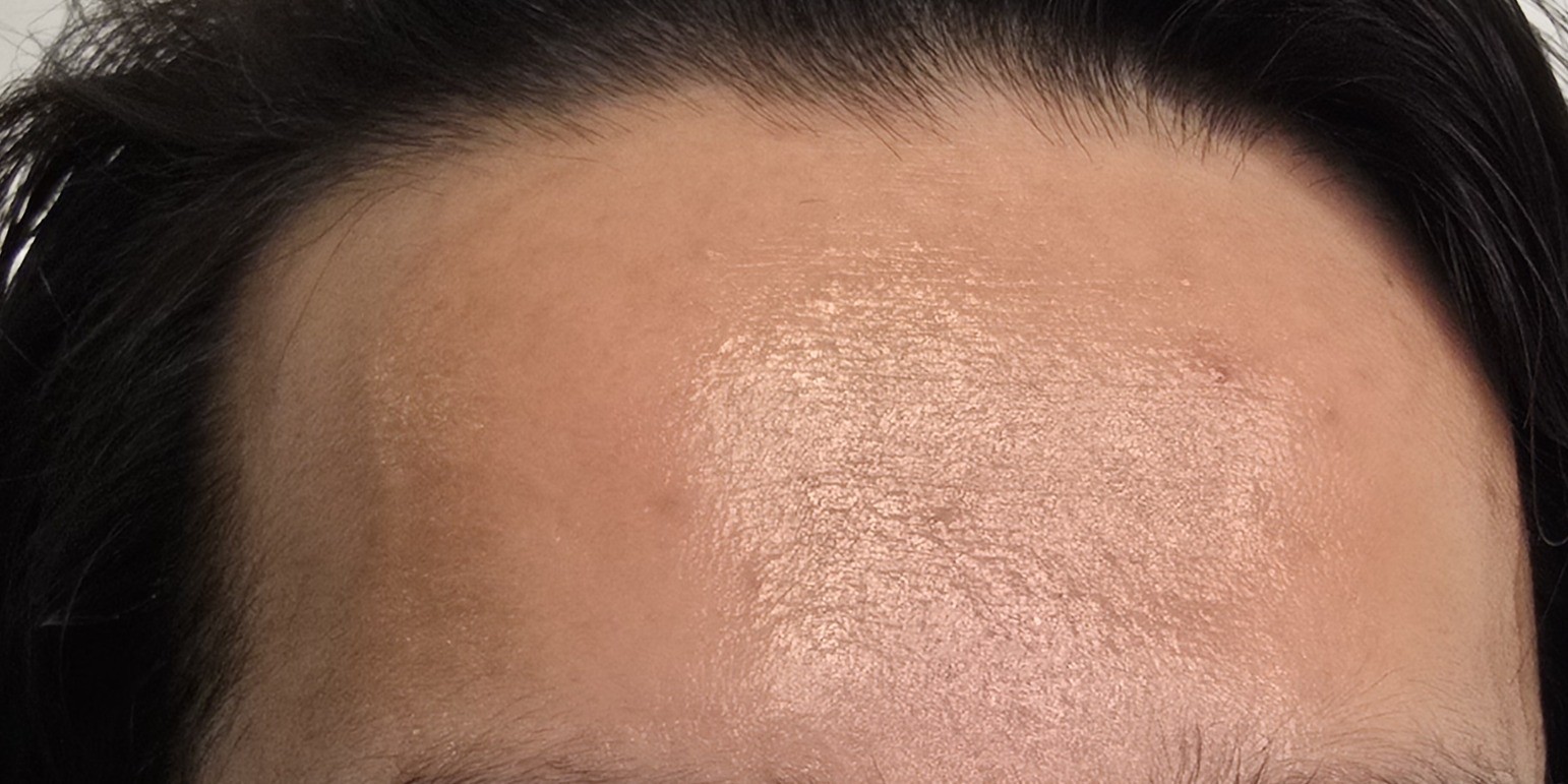 Forehead after using Ultimate Beautician Gift Set