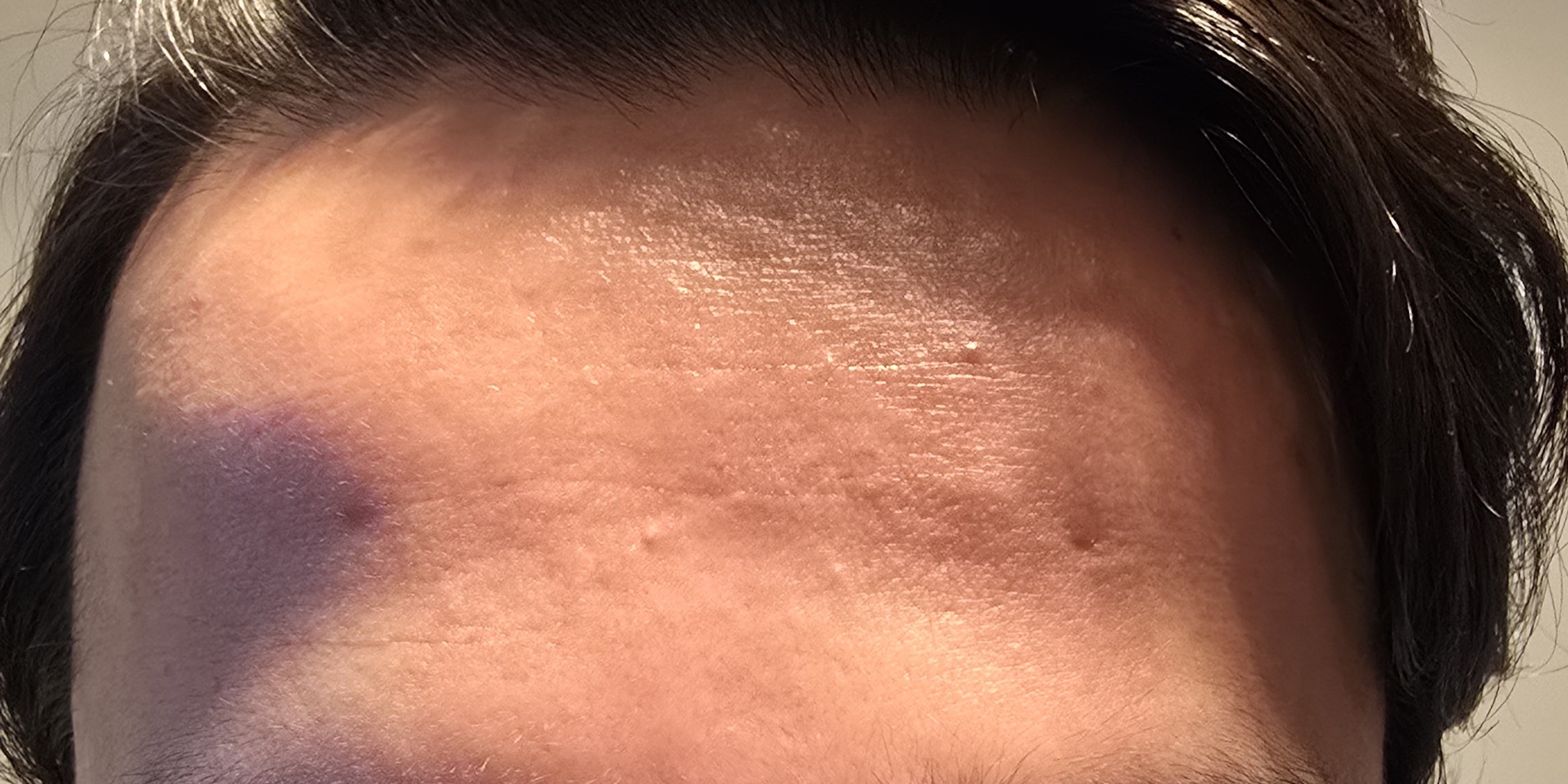 Forehead before using Ultimate Beautician Gift Set