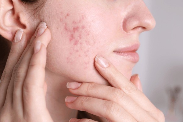 Woman holding the side of her face with blemishes and acne on her lower cheek
