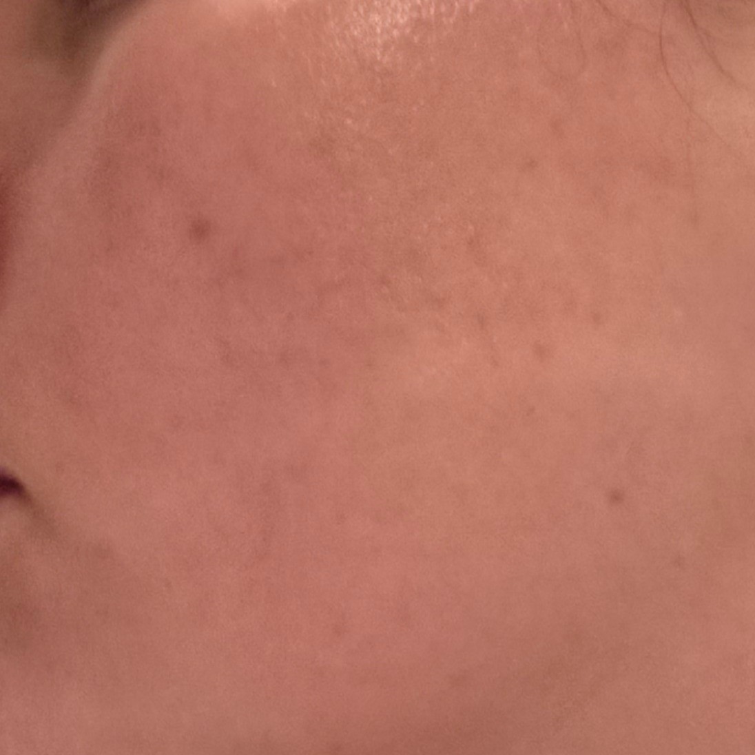 Skin before using Medicube Kojic Acid Toner