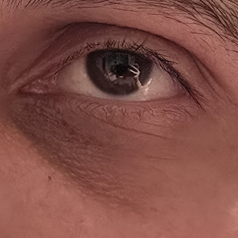 Eye taken before Heveblue device use