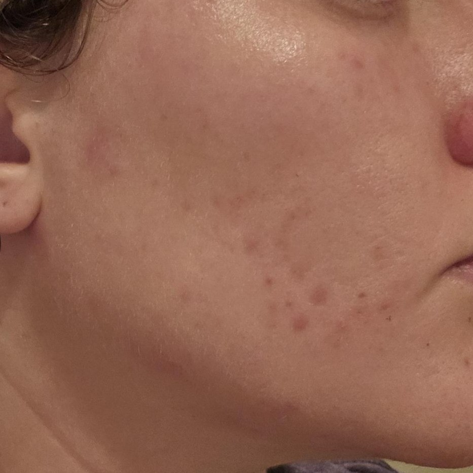 Chin after using Medicube AGE-R Booster Cleanser Head