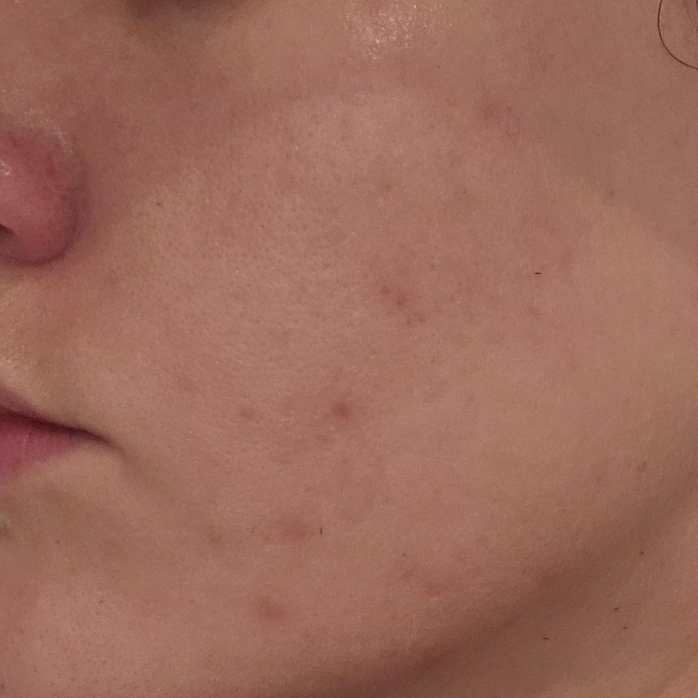 Skin after using HYAAH Licorice First Essence