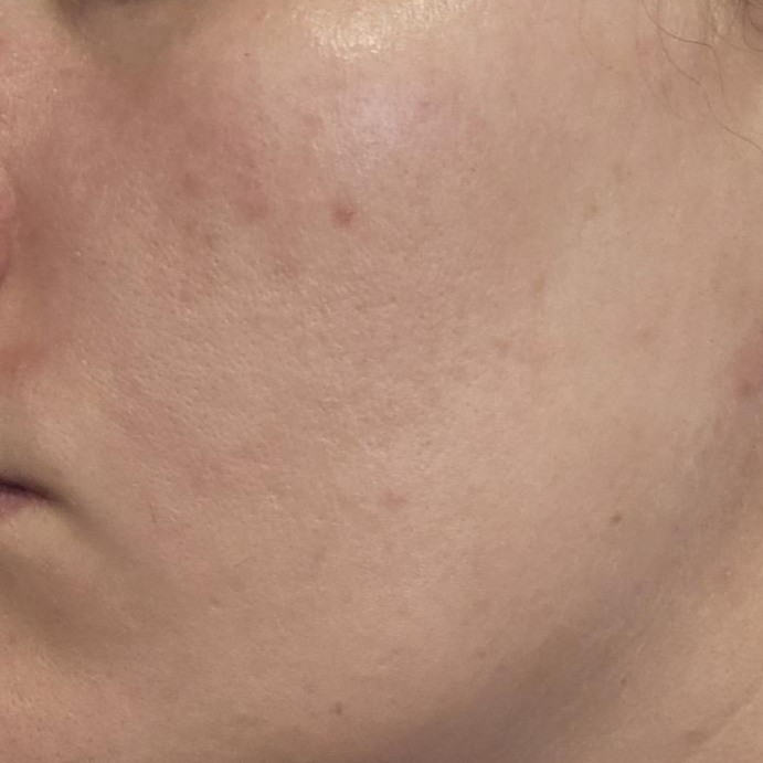 Hydrated and calmer skin after using Anua Rice 7 Ceramide Serum