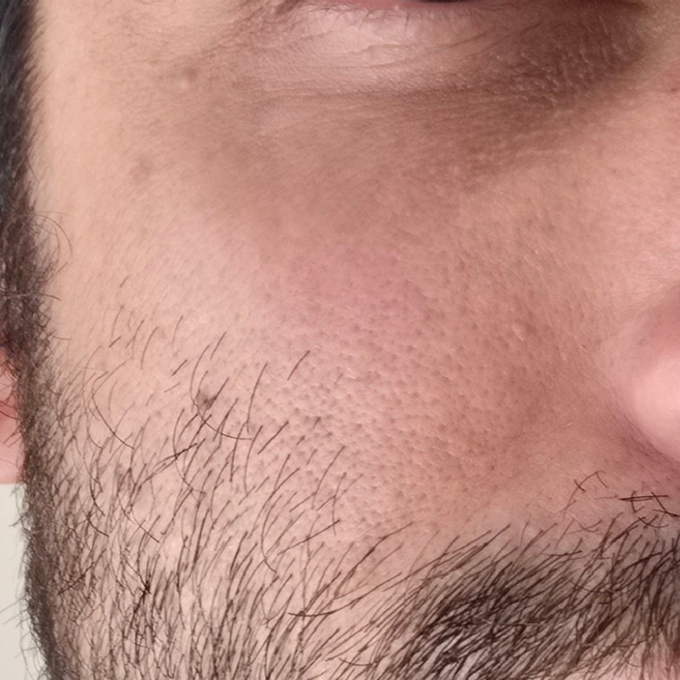 Skin before using Dr Althea 345 Barrier Cream