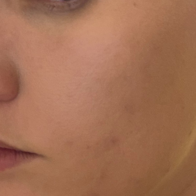 After blending Blanc Cover Cream Stick Medium on Skin