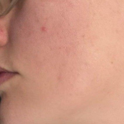 Close up of cheek after 10 minute mask. There's an immediate reduction in redness, less visible pores