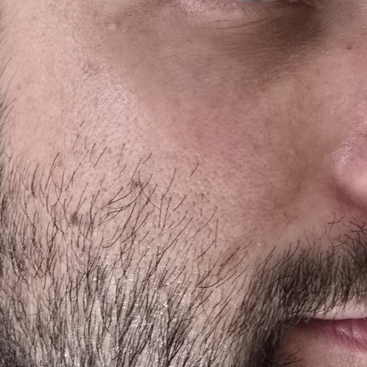 Before using Centellian24 Madeca Cream Time Reverse