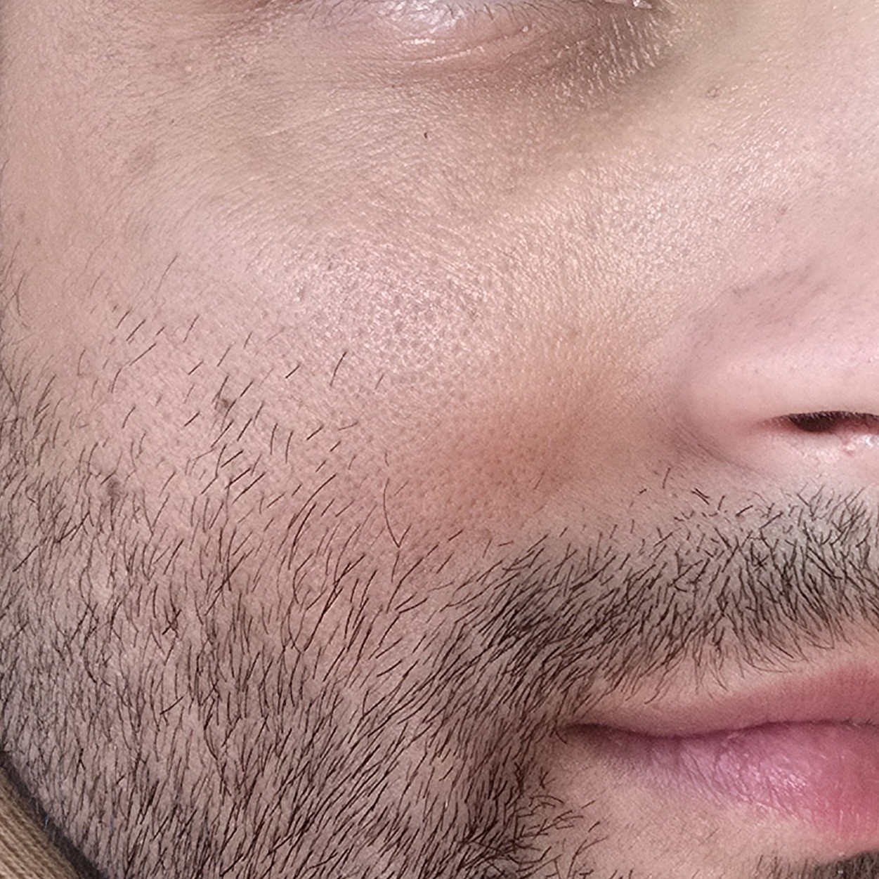Cheek Before Using Medicube PDRN Peptide Balm