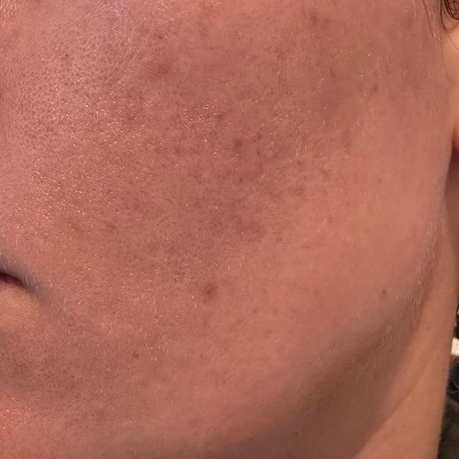 Before picture: shows skin with healing acne spots and large pores
