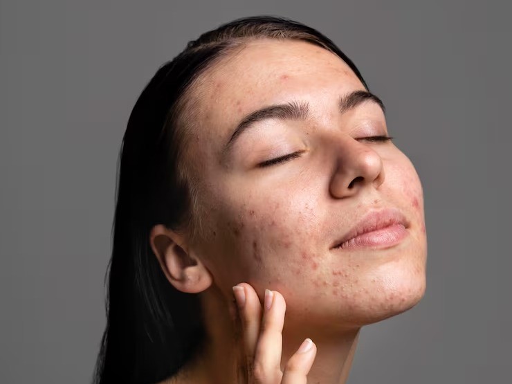 Young model with acne lifting her chin with eyes closed