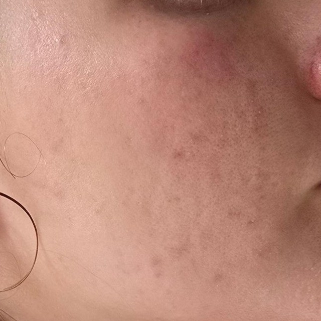 Face close-up before using Isntree Green Tea Fresh Emulsion