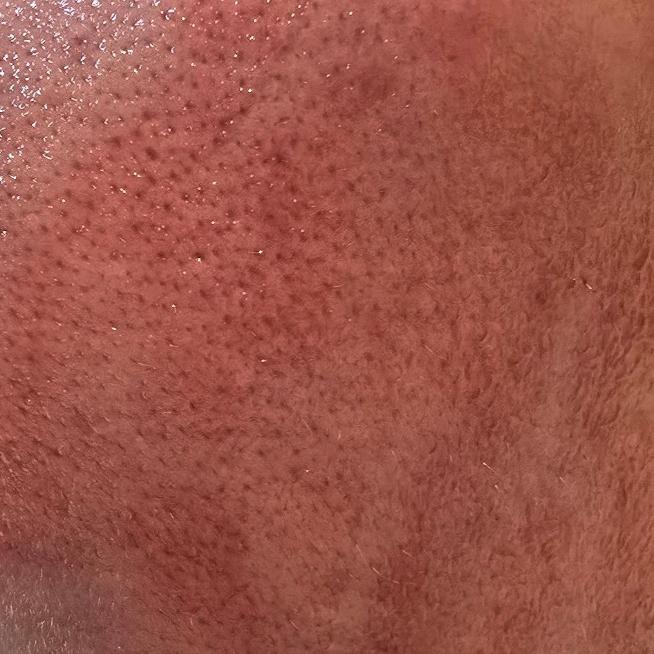 Close up of skin pores with Heimish Rx AHA BHA serum