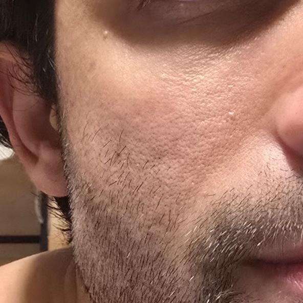 Cheek before using Beauty of Joseon Red Bean PDRN + Peptide Serum