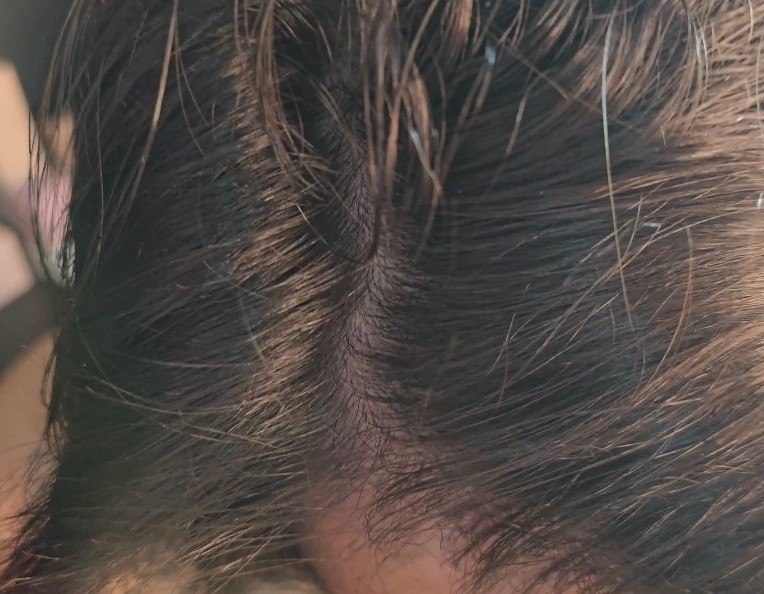Scalp After Using Aromatica Trial Kit