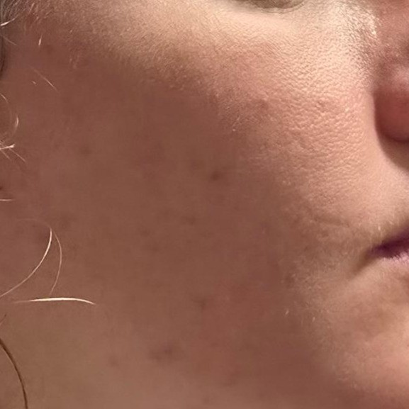 Cheek showing before Be The Skin Bubble Mask Use