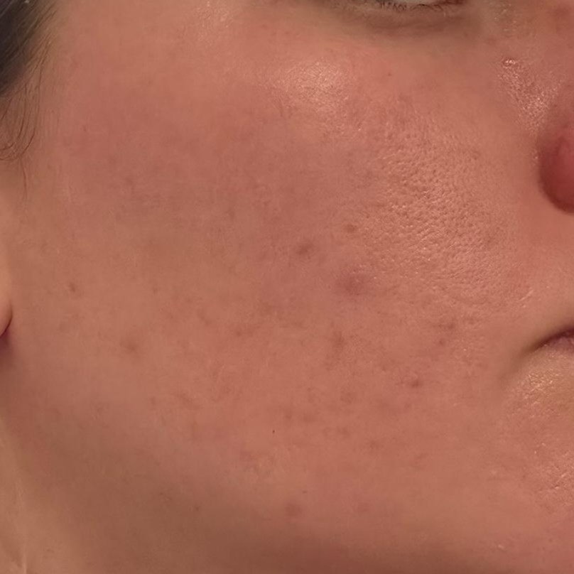 Skin before using KSECRET Seoul 1988 Essence Snail Mucin 97% + Rice