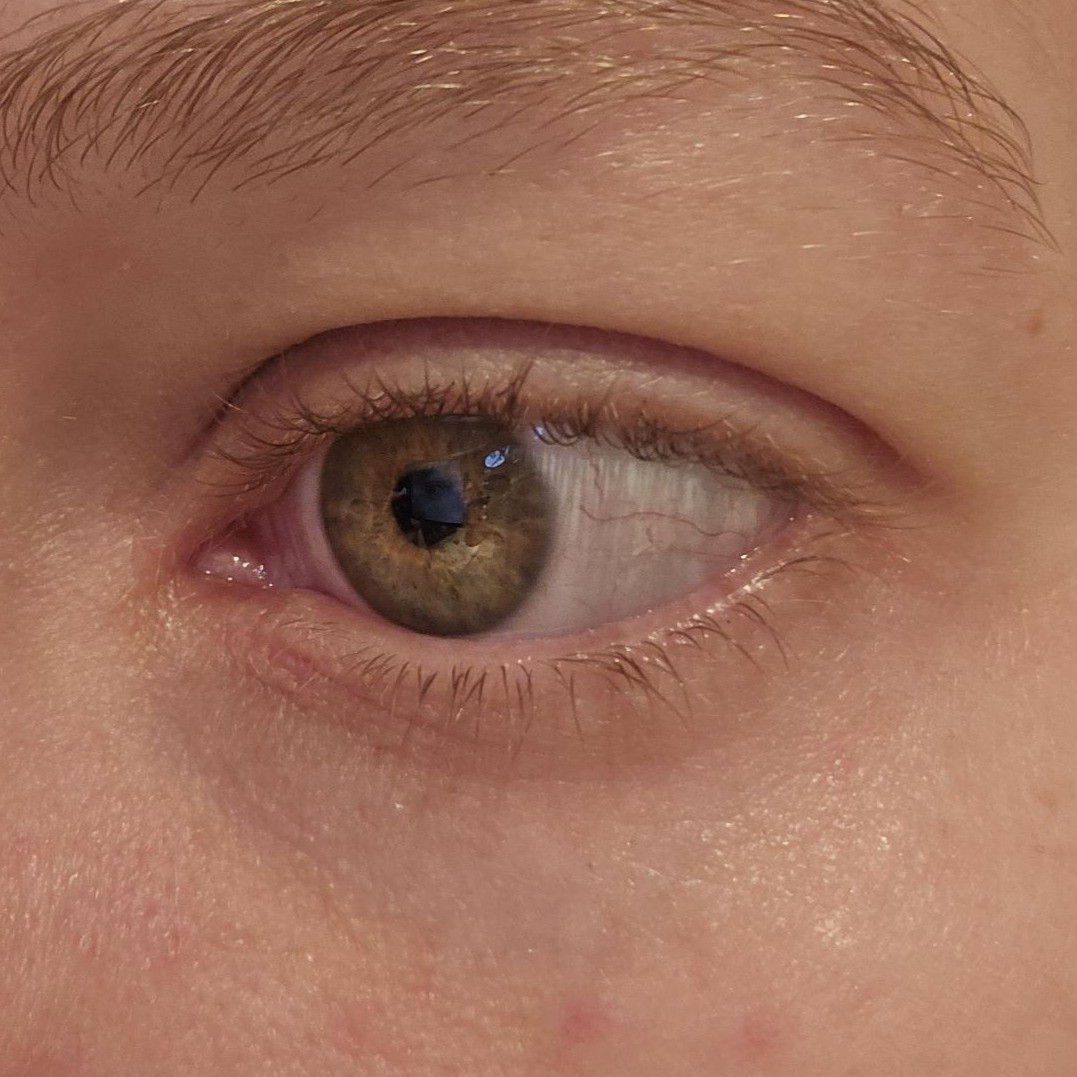 After using Numbuzin NAD No.9 Under Eye patch