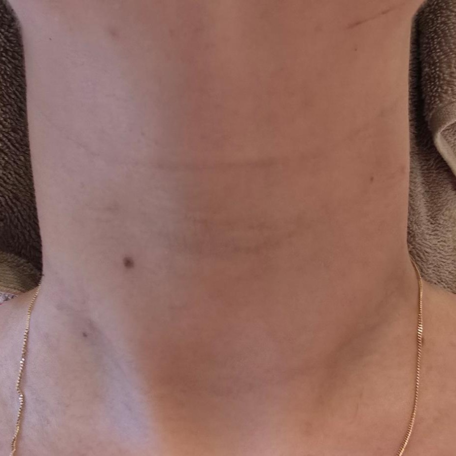 Neck before using Petitfee Gold Hydrogel Neck Mask