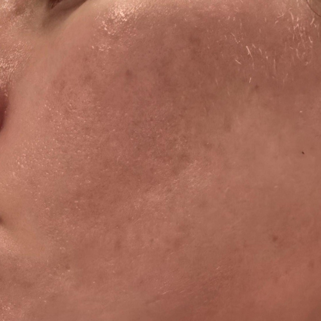 After picture using two weeks exosome serum with brighter skin tone and lifted cheek bone effect