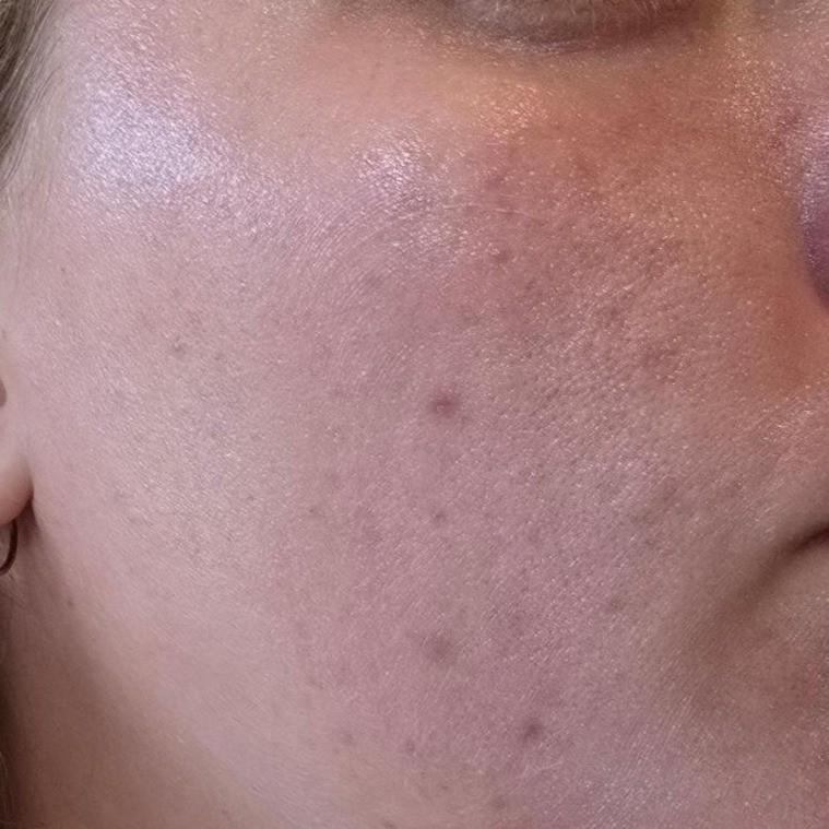 Skin barrier before using Medicube Zero Pore Sun Serum