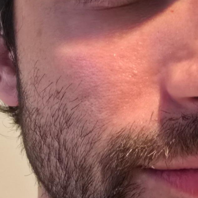 Cheek after using Beauty of Joseon Red Bean PDRN + Peptide Serum