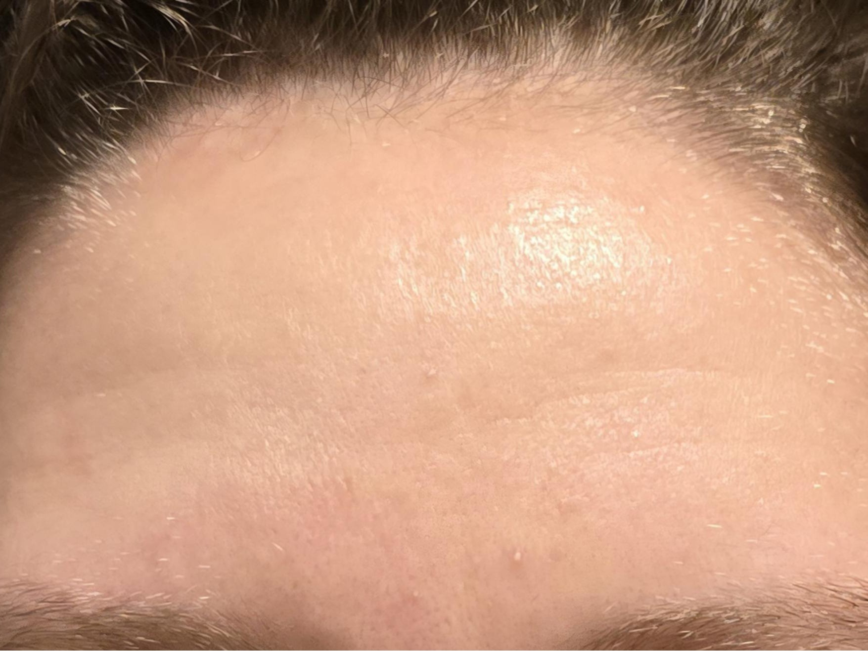 After forehead Pic - Hydrated