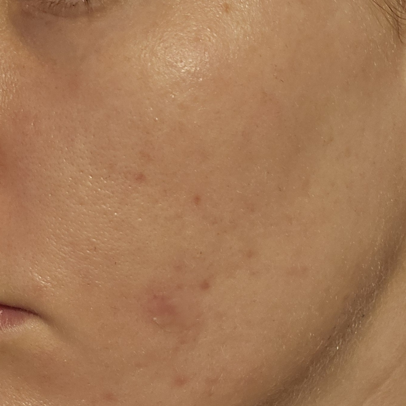 Cheek After using Dr Althea Vitamin C Boosting Serum