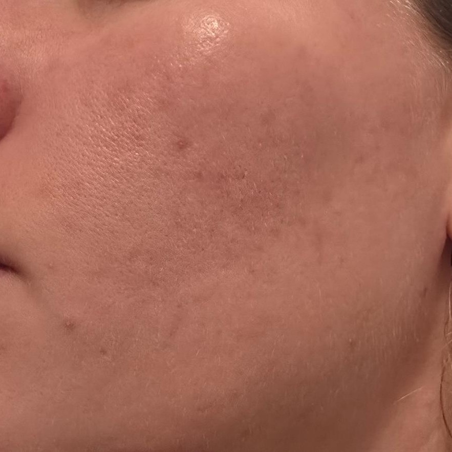 Skin barrier before using Medicube PDRN Pink Peptide Serum (showing redness and irritation)