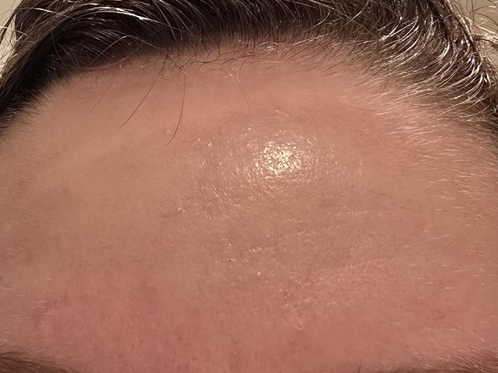 Before Forehead Dry - Picture