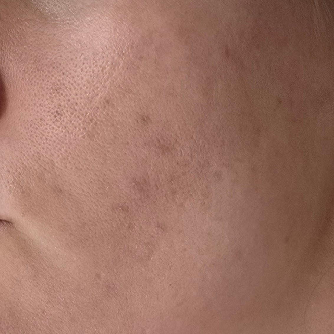 Skin before using Mary&May Rice Glutathione LHA Oil Cleanser