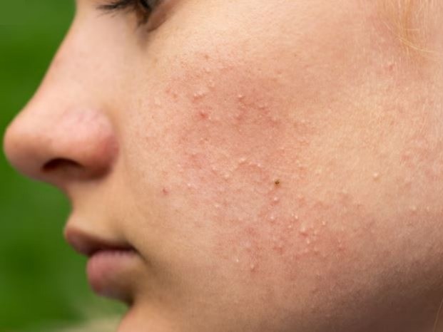 Young woman with her face turned showing monomorphic. raised dots that resemble fungal acne lesions