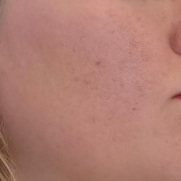 Cheek showing after Be The Skin Bubble Mask Use