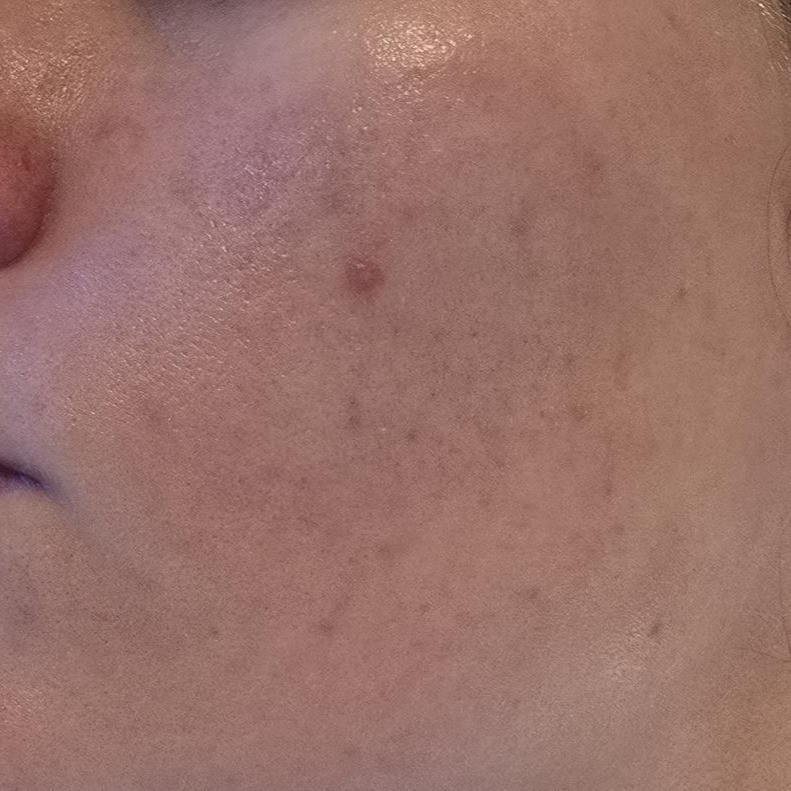 Before shot of acne - close up of cheek